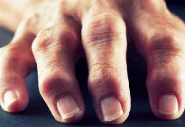 остеоартроз пальцев рук