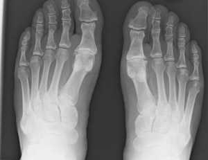 рентген стопы