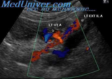 профилактика гестоза