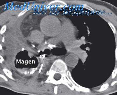 бронхиальные свищи