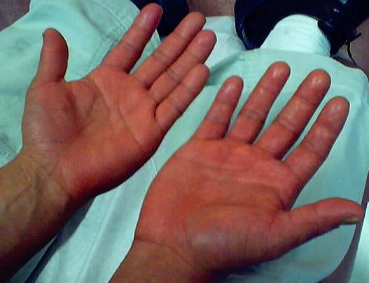 Эритроцитоз