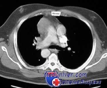 вторичное кровотечение