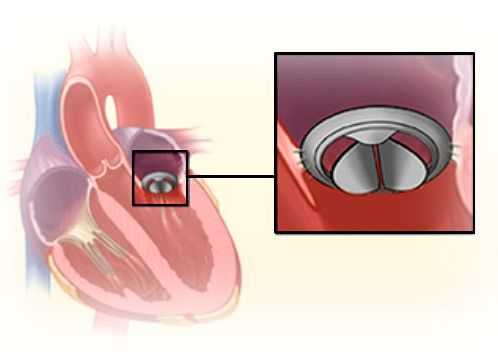 Протезирование митрального клапана