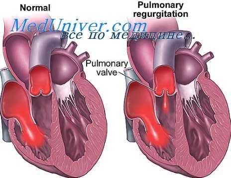 митральная недостаточность