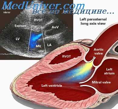 недостаточность митрального клапана
