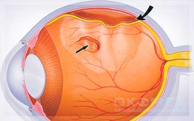 Профилактика отслоения сетчатой оболочки