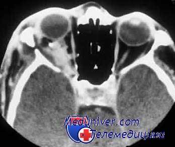 антибиотики после травмы глаза