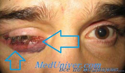 посттравматическая инфекция глаза