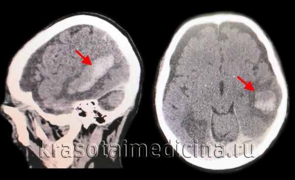 КТ головного мозга. Геморрагический инсульт, обширная интрапаренхиматозная гематома в левой гемисфере