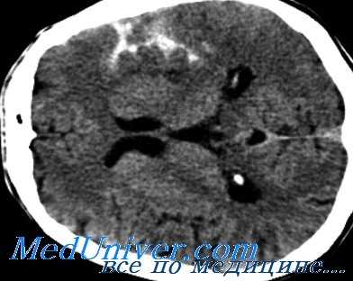 субарахноидальное кровоизлияние