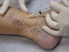 Сосудистые звездочки - косметический дефект, который устраняется микросклеротерапией