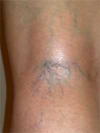 Сосудистая звездочка под коленом фото