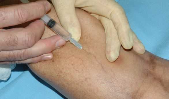 Склеротерапия