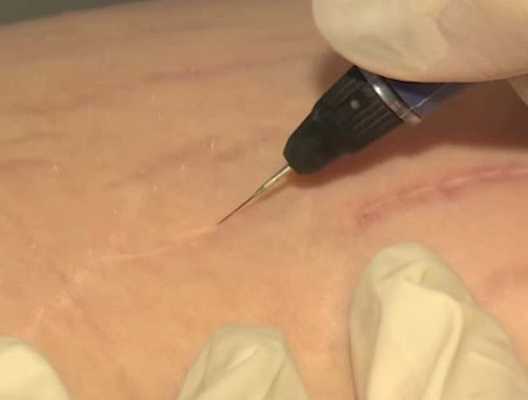 Радиочастотная абляция сосудистых звездочек