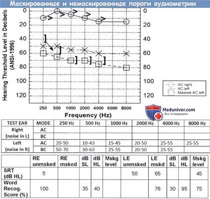 Маскированные и немаскированные пороги аудиометрии