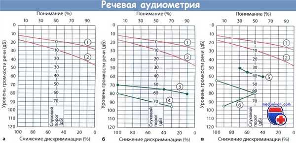 Речевая аудиометрия