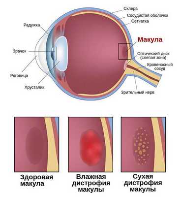 Макулярная дегенерация
