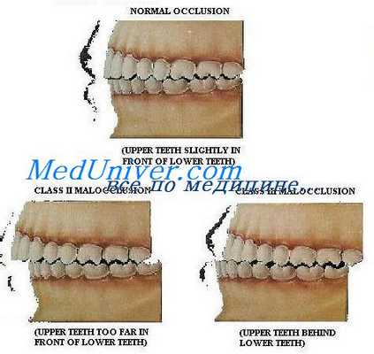 аномалии прикуса
