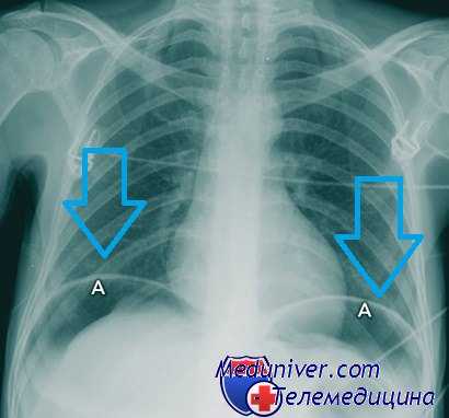 гастродуоденальные кровотечения