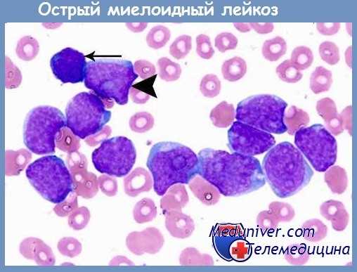 острый миелоидный лейкоз