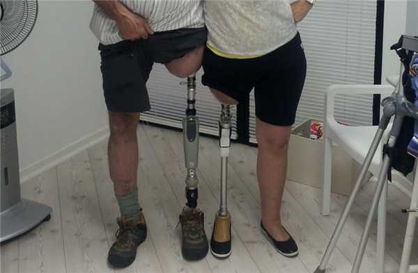 Ампутация конечностей