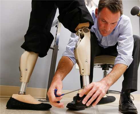 Услуги протезирования после ампутации