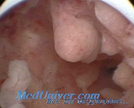 дисфункциональные ювенильные кровотечения