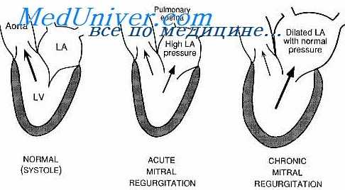 недостаточность двустворчатого клапана