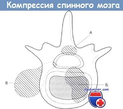 Компрессия спинного мозга