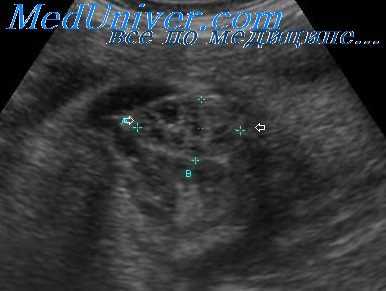 лоханочно-мочеточниковое соустье