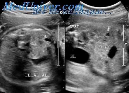 первичный мегауретер у плода