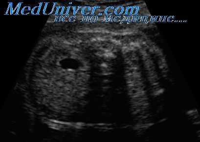 инфравезикулярная обструкция