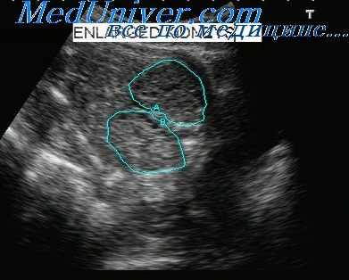 гидронефроз у плода