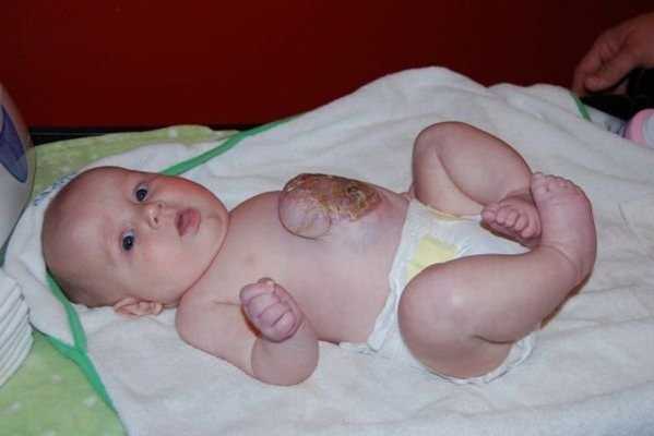 Омфалоцеле