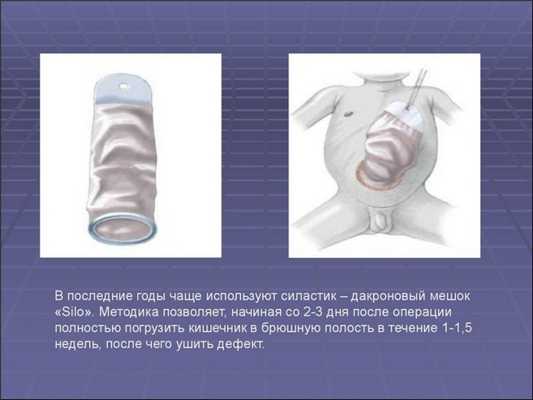 Операция при омфалоцеле