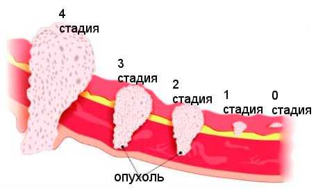 Аспирационная биопсия эндометрия и гистерорезектоскопия