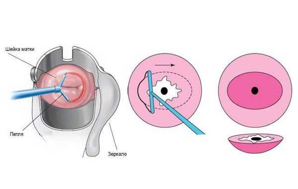 Радиоволновое лечение эрозии