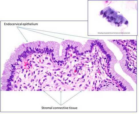эрозия шейки матки эпителий