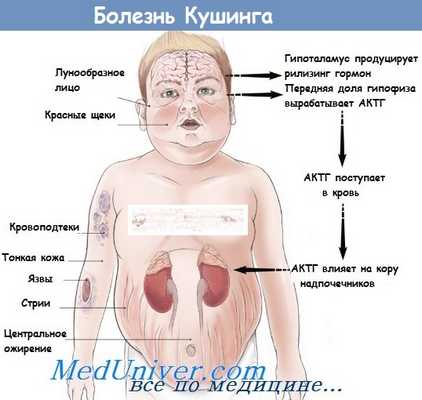 болезнь иценко-кушинга