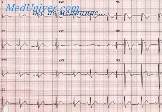 аутосомно-рецессивная кпжт