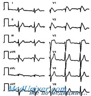 синдром бругада