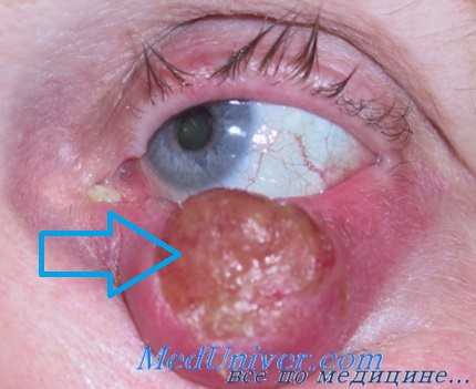 рост рака века