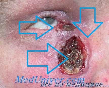 рост рака века