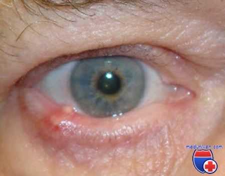 прогрессирование рака века