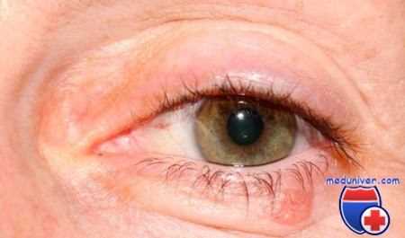 прогрессирование рака века