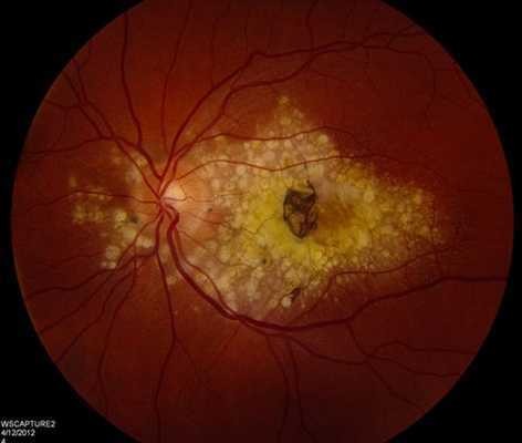 Другие заболевания сетчатки