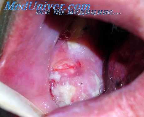 фиброма полости рта