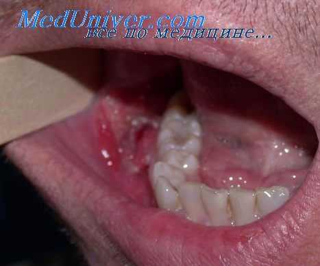 фиброма полости рта