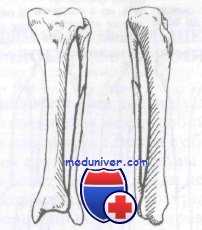 перелом костей голени