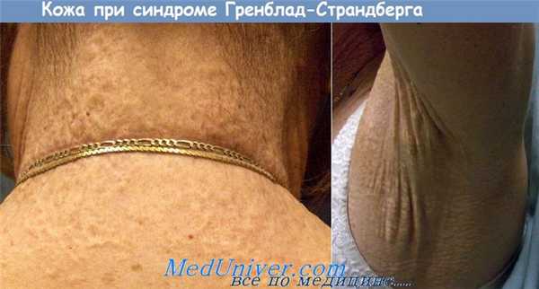 Псевдоксантома эластическая - синдром Гренблад-Страндберга